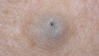 Cyst