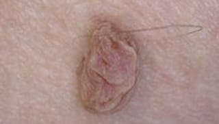 Skintag