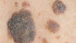 keratosis