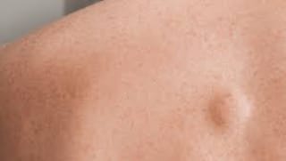 lipoma