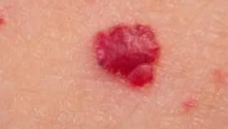 cherry Cherry Angiomas