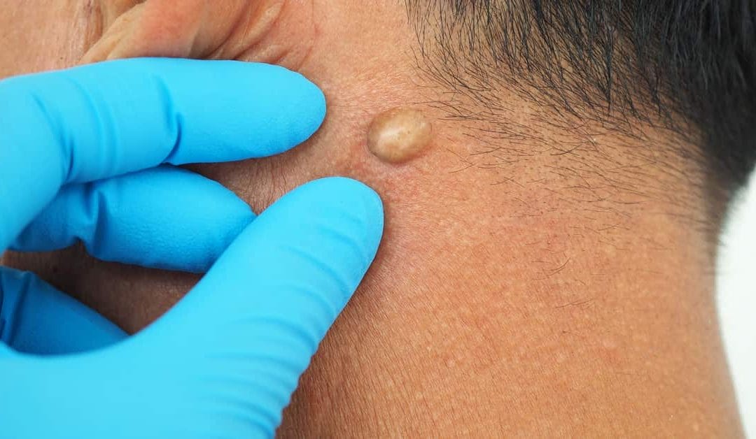 Understanding Cysts: What They Are and How to Remove Them